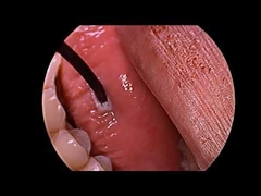 جهاز مولد بلازما بترددات الراديو لعلاج الشخير مع مسبار متعدد الوظائف