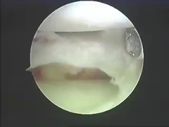 الأجهزة الكهربائية الجراحية أنظمة الاجتثاث منتجات العمود الفقري والمفاصل