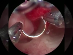 تكنولوجيا باردة الكهرباء الجراحية البلازما لعمليات الأمراض البولية