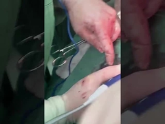 مسبار أمراض الكبد PLA408 للجراحة المفتوحة